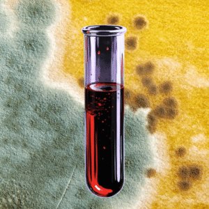 Allergy to Alternaria alternata (mold allergen)